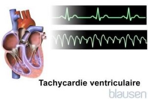 La Tachycardie Ventriculaire | SOS COEUR